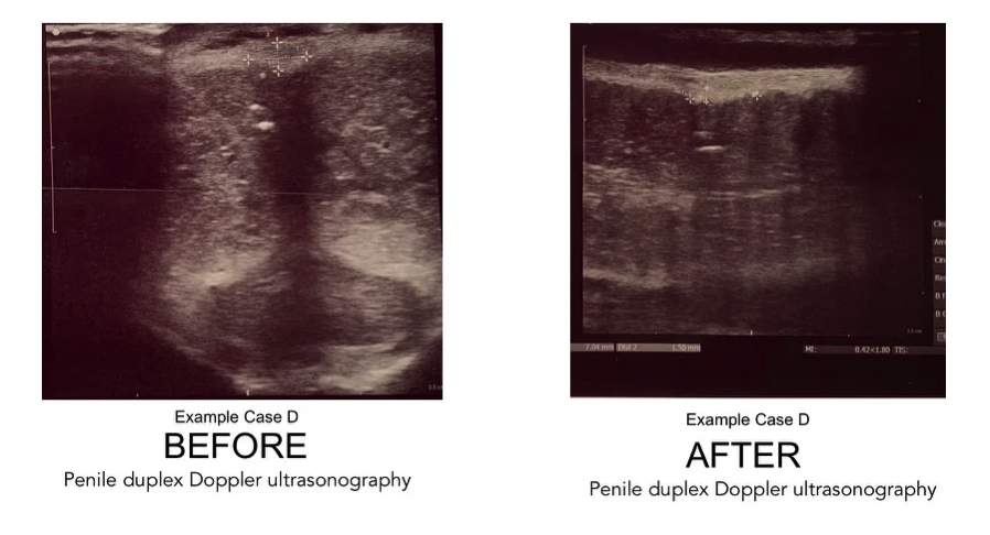 Technology The Peyronies Disease Breakthrough 